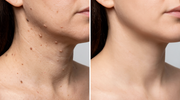 Skin Tag Removal Kit thumbnail 5