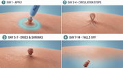 Skin Tag Removal Kit thumbnail 2