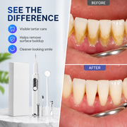 Portable Ultrasonic Teeth Cleaner and Tartar Remover Set thumbnail 2